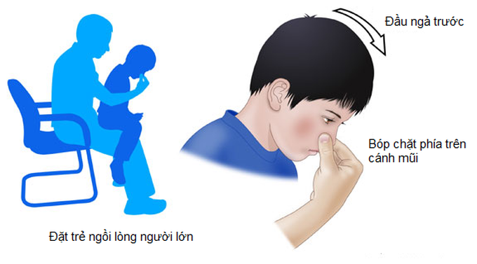 Chảy máu cam ở trẻ: Khi nào cần lo lắng?